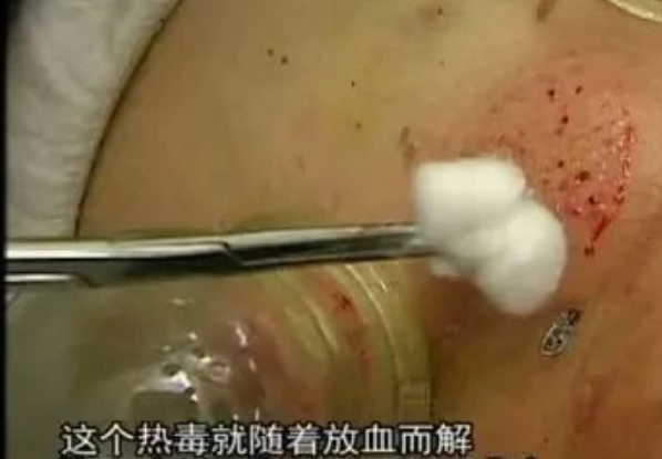 带状疱疹非 “意外”！5 大诱因需警惕，传统调理方法参考